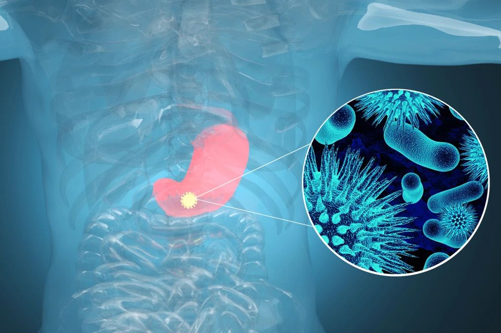 腫瘤標(biāo)記物CA72-4：“胃”，你還好嗎？